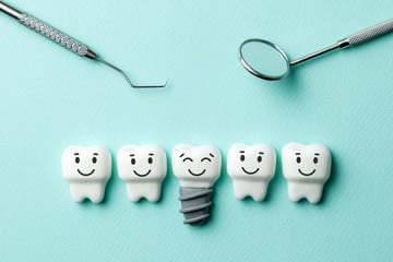 Dental-implant-7