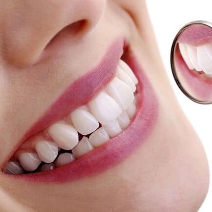 img-At-Home-Teeth-Whitening