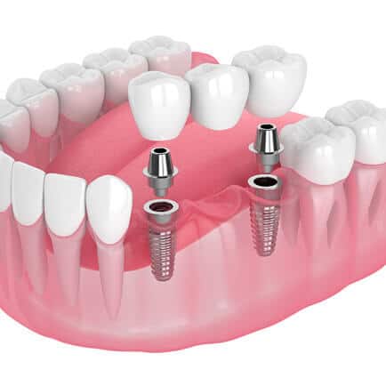 img-Benefits-of-Dental-Implants