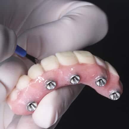 img-How-Do-Implant-Retained