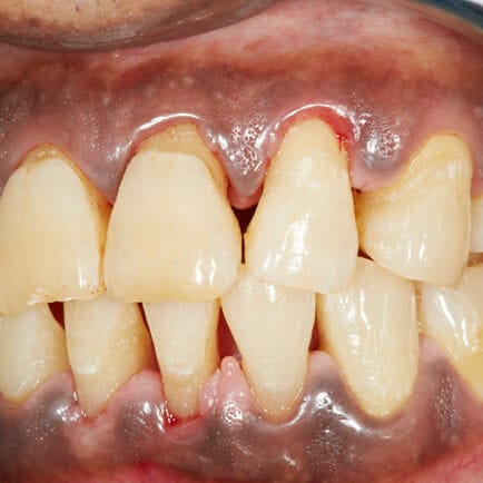 img-Symptoms-of-Gum-Disease