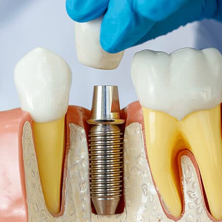 img-The-4-Step-Dental-Implant-Process