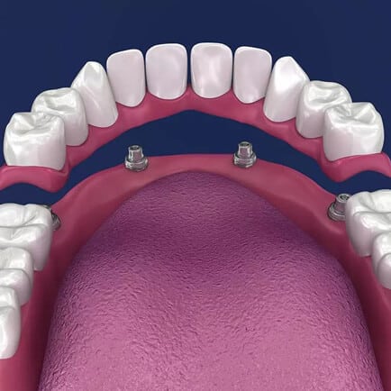 img-The-Implant-Retained-denture