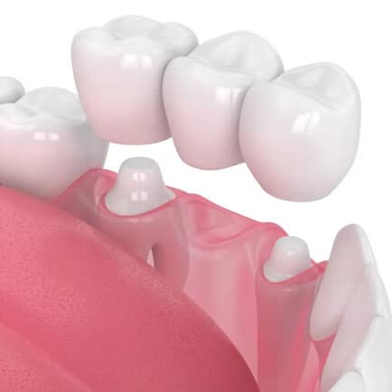 img-What-Are-Dental-Crowns