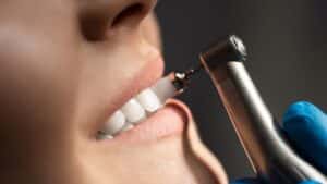 Know The Importance Of Professional Dental Cleaning