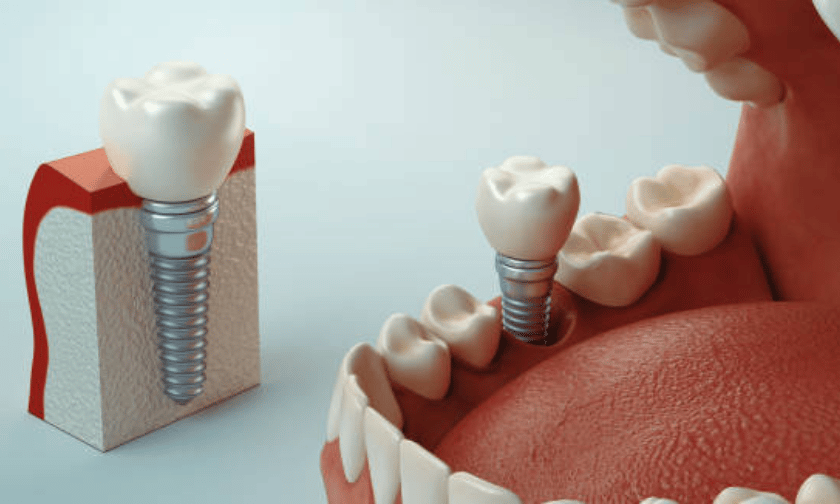 Dental Implants