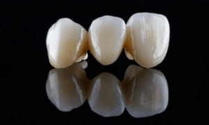 Know about dental crowns & bridges