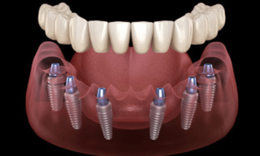 Implant retained dentures Blackwell