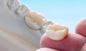 What Steps to Take When Considering a Porcelain vs Metal Dental Crown