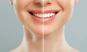 What to Expect From teeth whitening and What to do Afterward