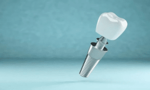 What Normally Occurs If Food Gets Stuck Under Dental Implants