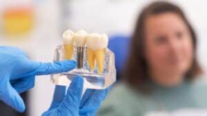 dental implants blackwell