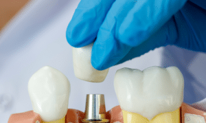 Dental Crown in Blackwell OK