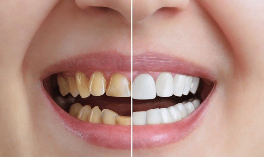 Teeth Whitening Treatments in Blackwell