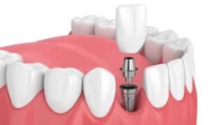 "Patient visits at Blackwell Dentistry, OK, for Dental Implants Treatment."
