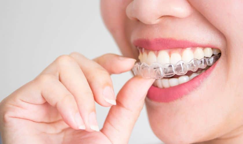 Invisalign