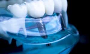 Dental Implants in Blackwell