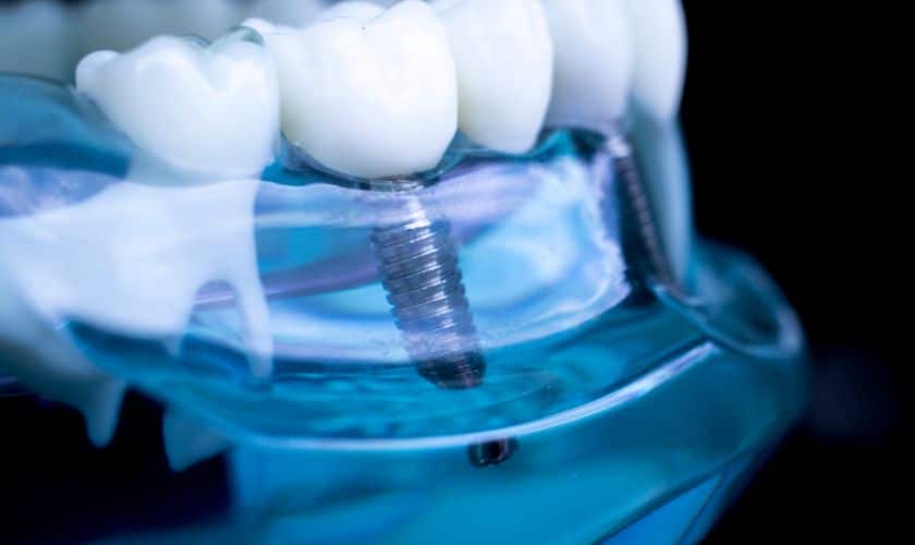 Dental Implants in Blackwell