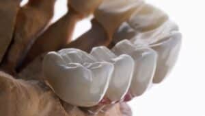 Enhance Your Smile with Dental Bridges