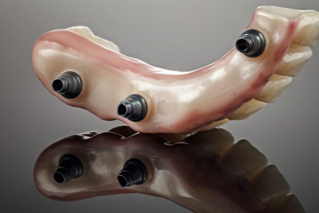 implant retained dentures in Blackwell