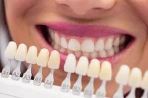 Veneers in Blackwell