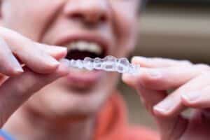 invisalign in Blackwell