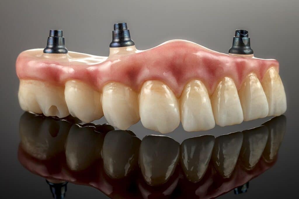 implant retained dentures in Blackwell