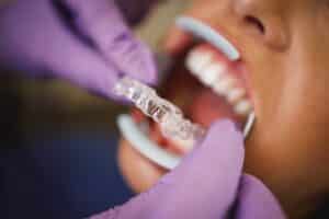 invisalign in Blackwell
