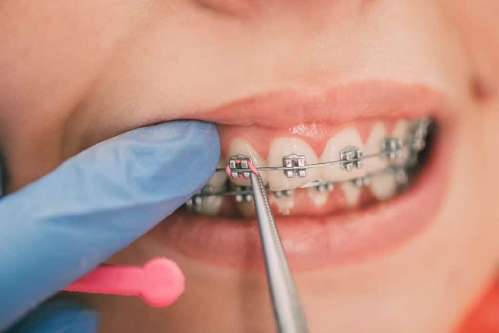 Adult braces adjustment to manage discomfort at family dentist in Blackwell, OK