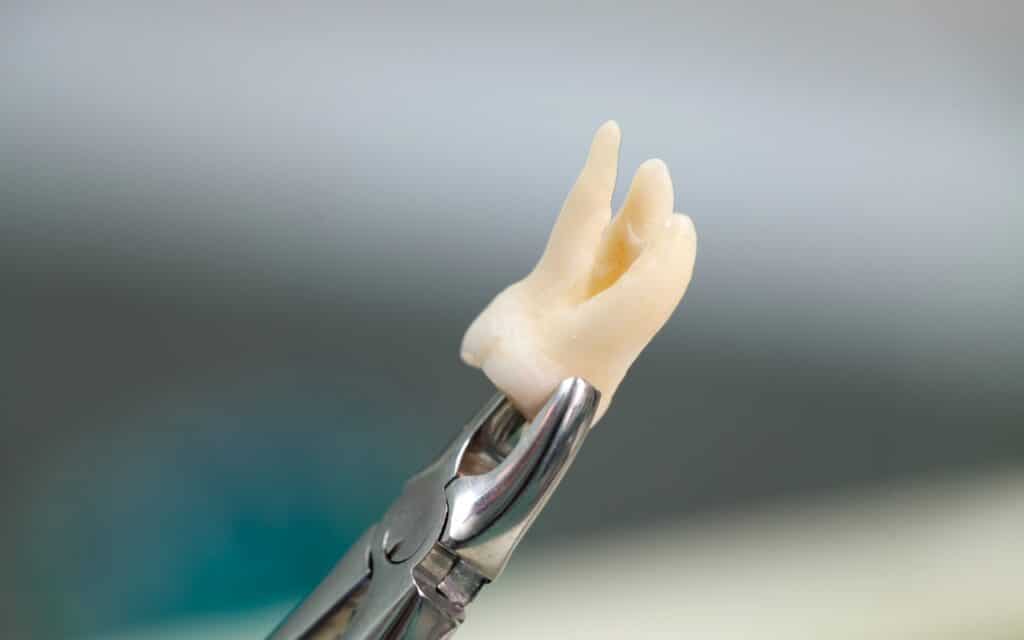 Wisdom Teeth Extractions