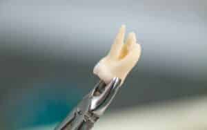 Wisdom Teeth Extractions