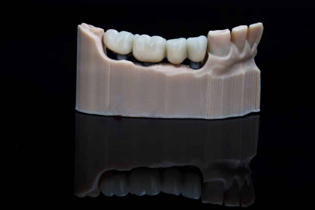 Implant Crowns & Bridges: Are They Right for You?