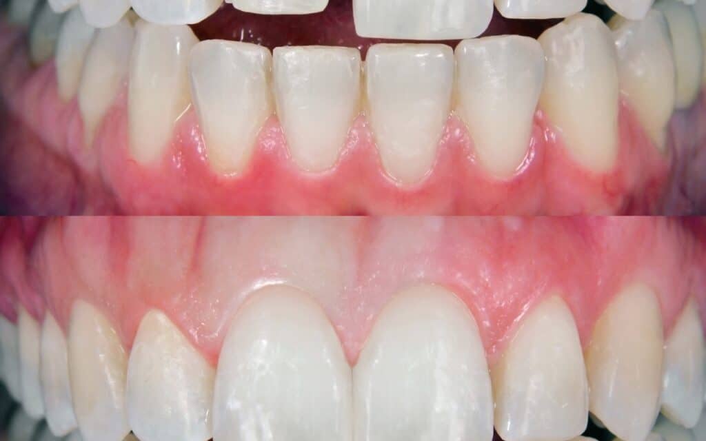 Stunning Veneers Before and After Transformations: Dentist Guide