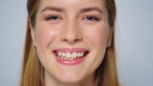 ClinCheck: Visualize Your Invisalign Journey Before Starting