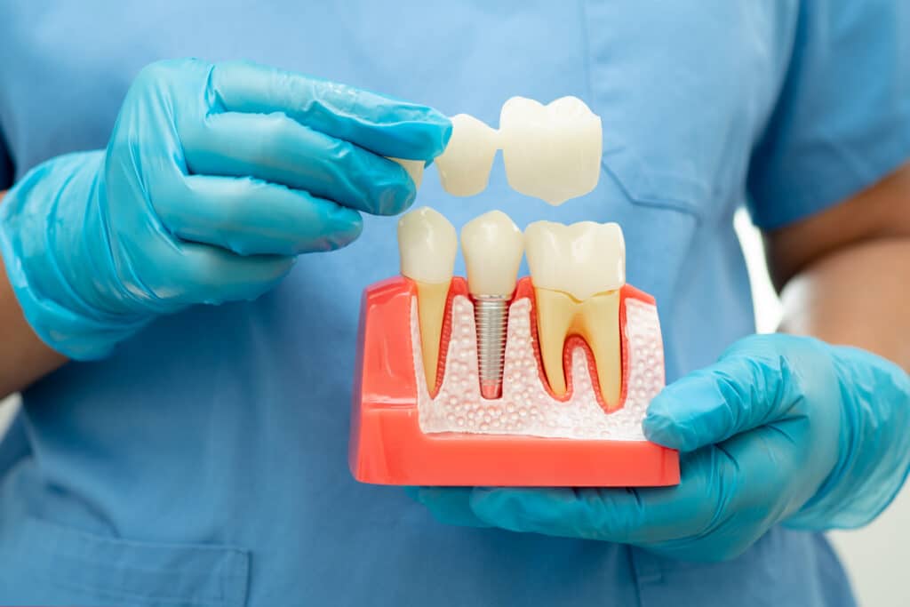 Dentist in blue gloves holding dental model showing tooth structure and implant procedure.