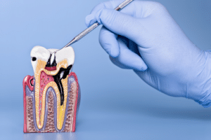 Periodontal Maintenance After Treatment — Long-Term Care Tips