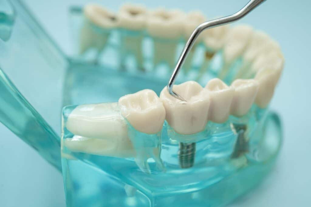 Restorative Dentistry in Blackwell
